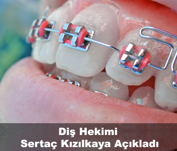Küçükçekmece İstanbul Şeffaf Plak diş tedavisi diş teli ile
