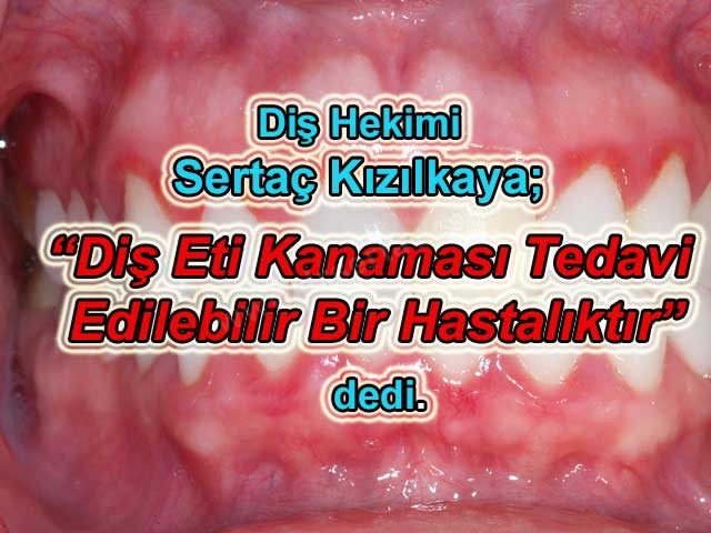 Diş eti kanaması ağız kokusuna da neden olur ve tedavi edilebilir bir hastalıktır İstanbul Küçükçekmece Diş Hekimi Sertaç Kızılkaya açıkladı