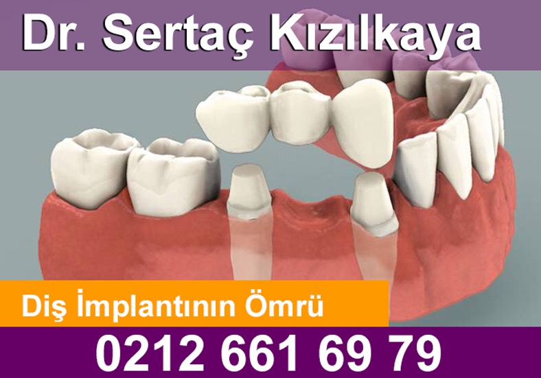 Diş implantının ömrü ne kadar diş hekimi Sertaç Kızılkaya Kız