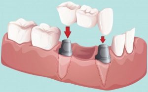 implant üzeri köprü