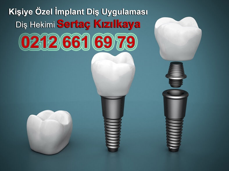 Kişiye özel implant